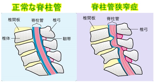 腰部脊柱管狭窄症